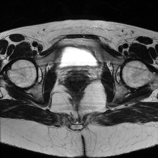 File:Cesarian section scar endometriosis (Radiopaedia 66520-75799 Axial T2 20).jpg