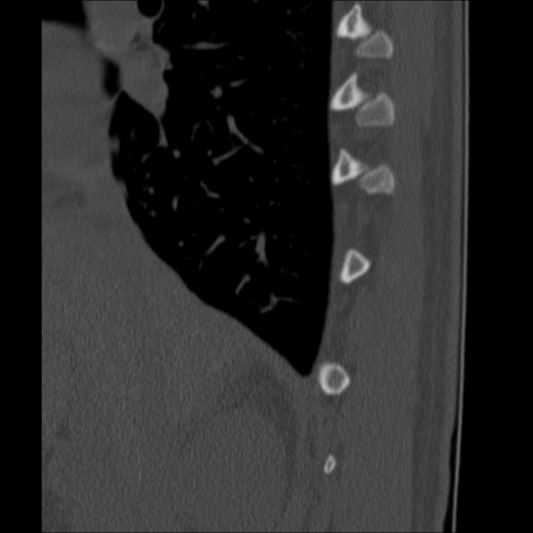 Chance fracture (Radiopaedia 36521-38081 Sagittal bone window 2).jpg