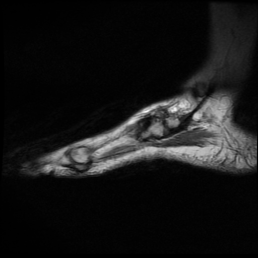 File:Charcot arthropathy (Radiopaedia 55056-61422 Sagittal T2 3).jpg