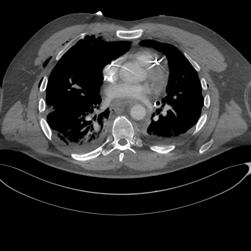 File:Chest multitrauma - aortic injury (Radiopaedia 34708-36147 A 165).png