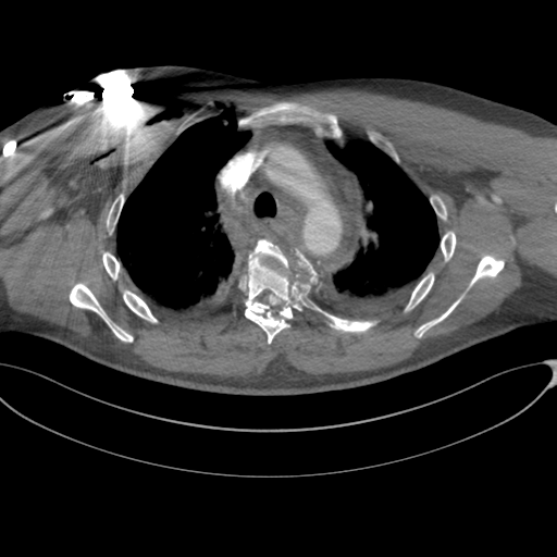 File:Chest multitrauma - aortic injury (Radiopaedia 34708-36147 A 93).png