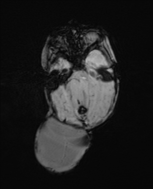 Chiari III malformation with occipital encephalocele (Radiopaedia 79446-92559 Axial SWI 29).jpg