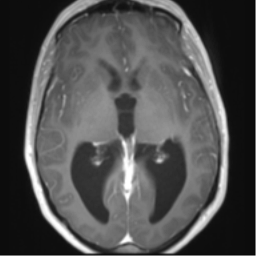 File:Chiari I malformation and obstructive hydrocephalus (Radiopaedia 41185-43978 Axial T1 C+ 16).png