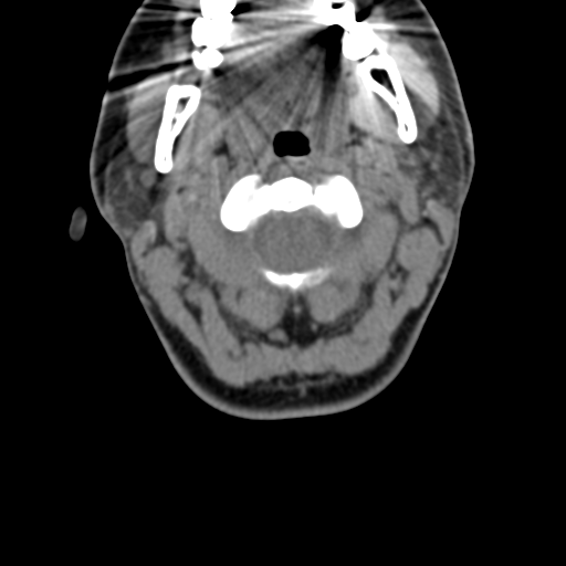 File:Chiari I malformation and obstructive hydrocephalus (Radiopaedia 41185-43981 D 37).png