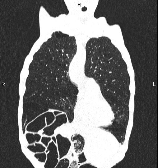 Chilaiditi sign (Radiopaedia 88839-105611 Coronal lung window 15).jpg
