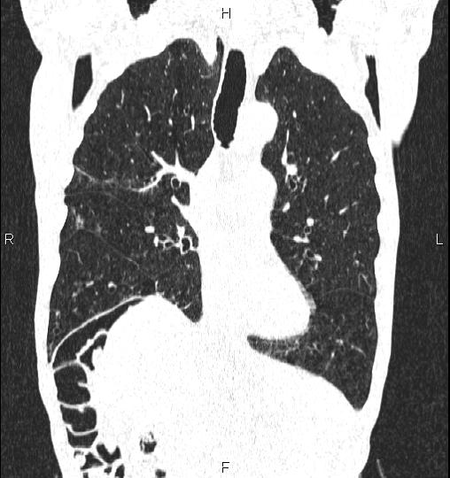 Chilaiditi sign (Radiopaedia 88839-105611 Coronal lung window 28).jpg