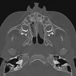 Choanal atresia (Radiopaedia 88525-105975 Axial bone window 19).jpg