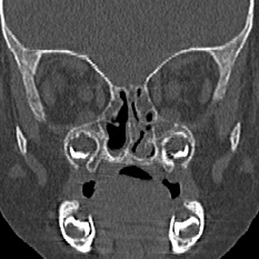 File:Choanal atresia (Radiopaedia 88525-105975 Coronal bone window 50).jpg