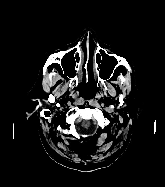 Cholangiocarcinoma with cerebral metastases (Radiopaedia 83519-98628 Axial non-contrast 10).jpg