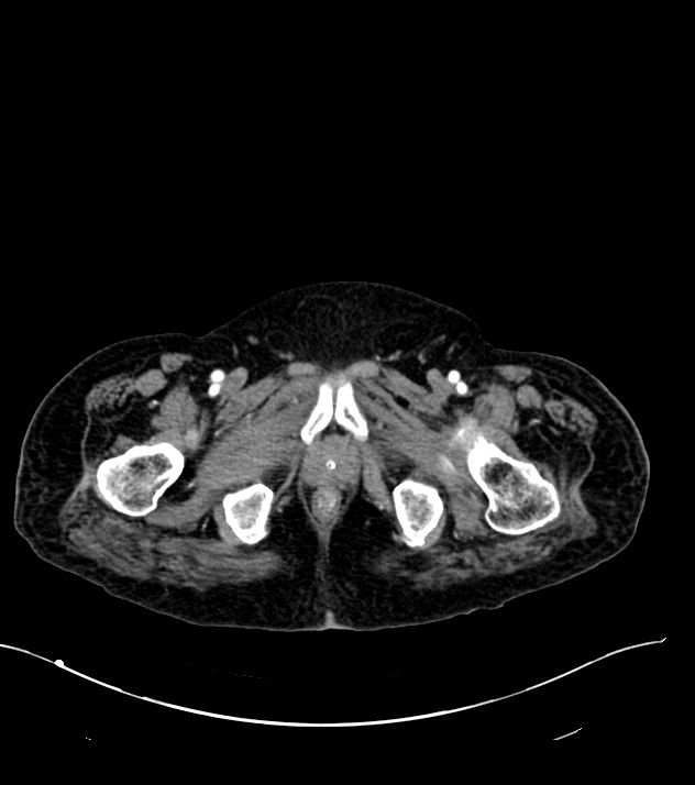 Cholangiocarcinoma with cerebral metastases (Radiopaedia 83519-98629 B 129).jpg