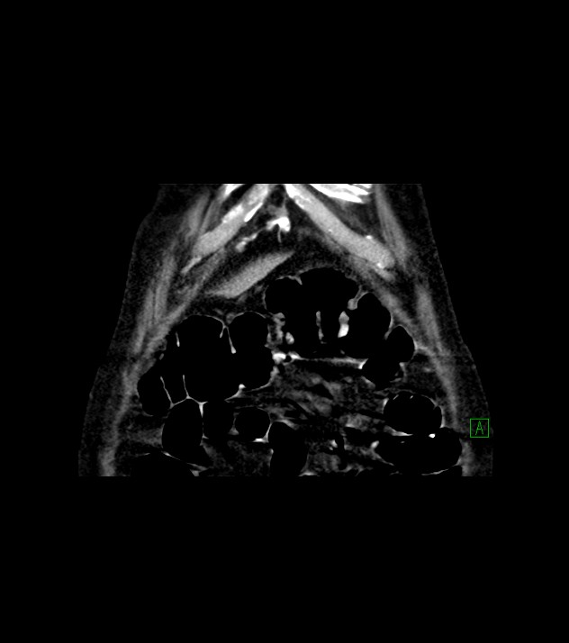 Cholangiocarcinoma with cerebral metastases (Radiopaedia 83519-98629 Coronal C+ delayed 9).jpg