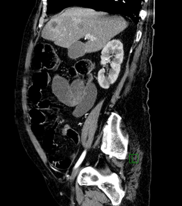 Cholangiocarcinoma with cerebral metastases (Radiopaedia 83519-98629 F 82).jpg