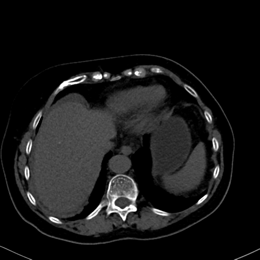 File:Cholecystitis - obstructive choledocholitiasis (CT intravenous cholangiography) (Radiopaedia 43966-47479 Axial 119).png