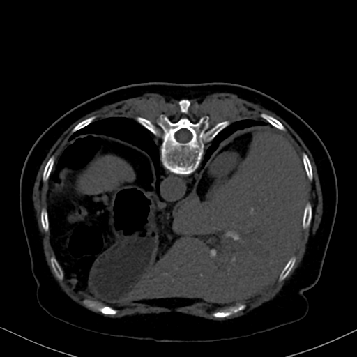 File:Cholecystitis - obstructive choledocholitiasis (CT intravenous cholangiography) (Radiopaedia 43966-47479 Axial 23).png