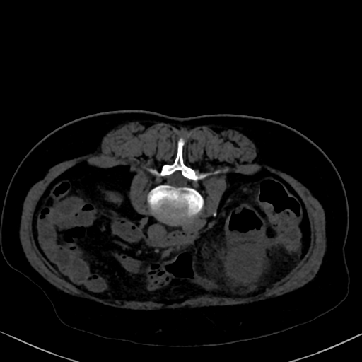 File:Cholecystitis - obstructive choledocholitiasis (CT intravenous cholangiography) (Radiopaedia 43966-47479 Axial 62).png