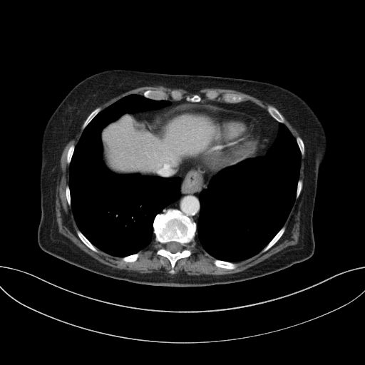 Cholecystoduodenal fistula due to calculous cholecystitis with gallstone migration (Radiopaedia 86875-103077 D 15).jpg