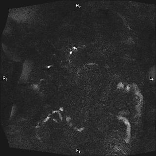 Choledochal cyst - type Ia (Radiopaedia 85673-101454 F 24).jpg