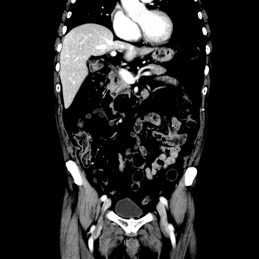 Choledocholiathiasis with normal caliber common bile duct (Radiopaedia 75368-86632 Coronal liver window 54).jpg