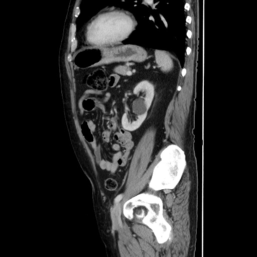 Choledocholiathiasis with normal caliber common bile duct (Radiopaedia 75368-86632 D 110).jpg