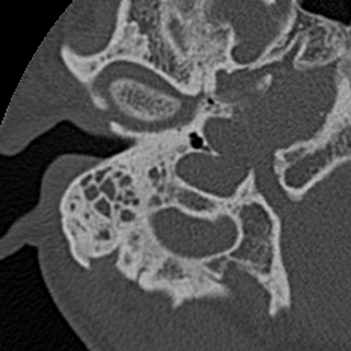 File:Cholesteatoma (Radiopaedia 15846-15494 bone window 25).jpg