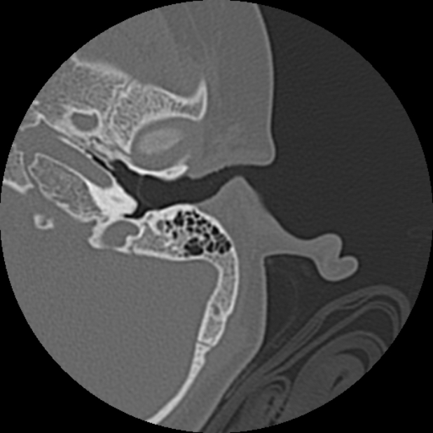 Cholesteatoma (Radiopaedia 73023-83750 Axial Left ear 25).jpg