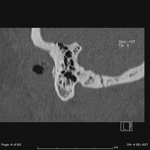 Cholesteatoma - external auditory canal (Radiopaedia 88452-105096 Sagittal bone window 4).jpg