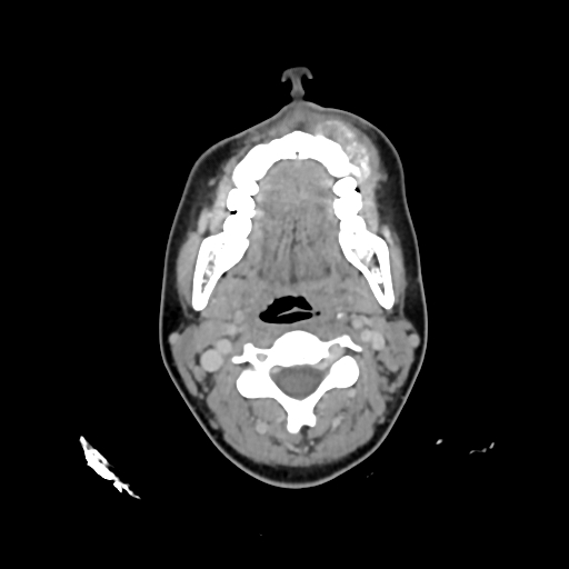 File:Chondroblastic osteosarcoma (Radiopaedia 67363-76741 Axial with contrast 22).jpg