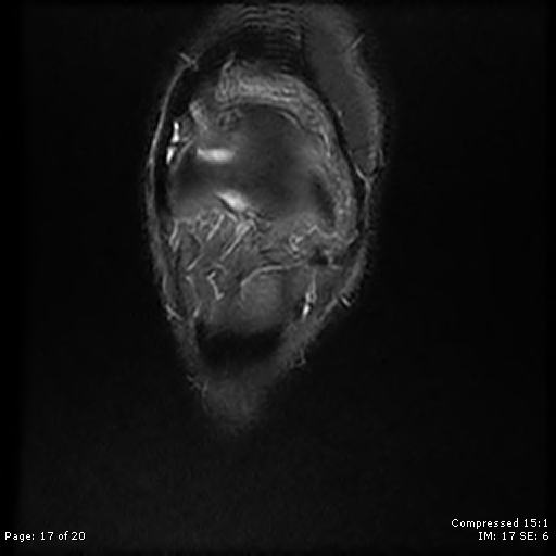 File:Chondroblastoma (Radiopaedia 25725-25891 Coronal STIR 17).jpg