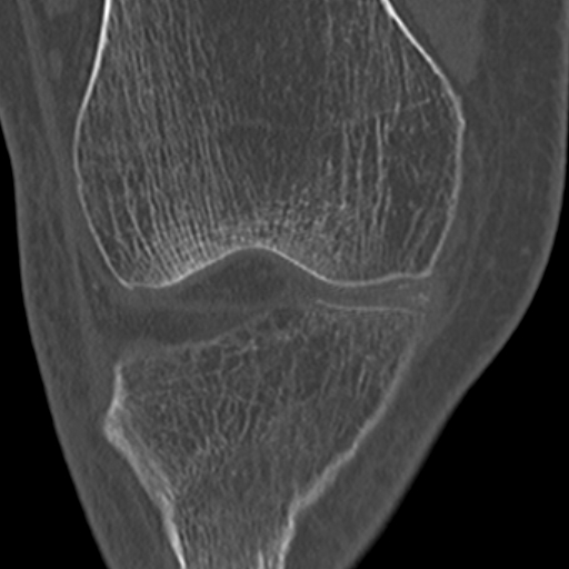 Chondrocalcinosis (Radiopaedia 16275-15955 Coronal bone window 24).jpg