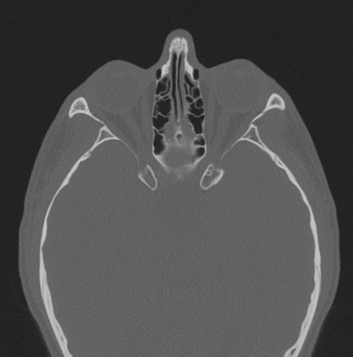 Chondrosarcoma (clivus) (Radiopaedia 46895-51425 Axial bone window 27).png