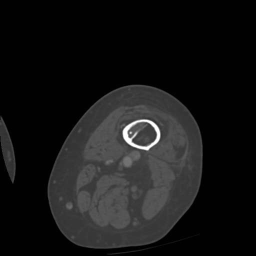 Chondrosarcoma - femur (Radiopaedia 64187-72954 Axial bone window 2).jpg