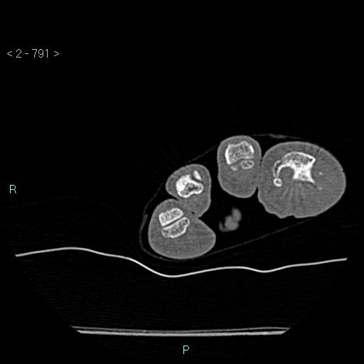 Chondrosarcoma - phalanx (Radiopaedia 69047-78812 Axial bone window 45).jpg
