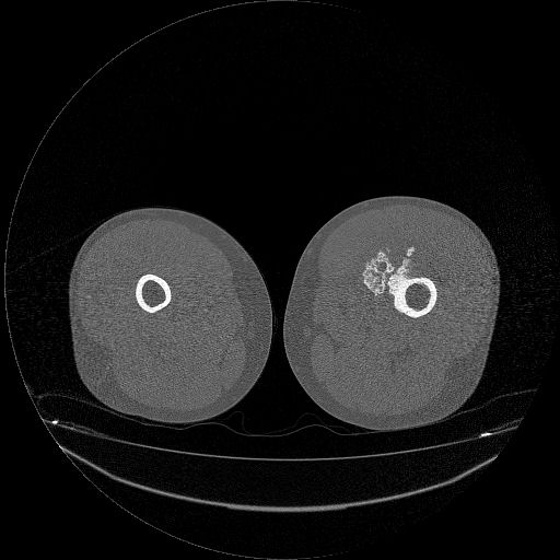 File:Chondrosarcoma arising from exostosis (Radiopaedia 59996-67507 Axial bone window 8).jpg