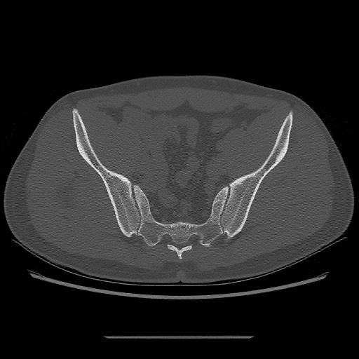 File:Chondrosarcoma of iliac wing (Radiopaedia 63861-72599 Axial bone window 69).jpg