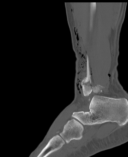 Chopart fracture (Radiopaedia 35347-36851 Sagittal bone window 47).jpg