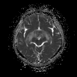 File:Chordoid glioma of third ventricle (Radiopaedia 91612-109340 Axial ADC 13).jpg