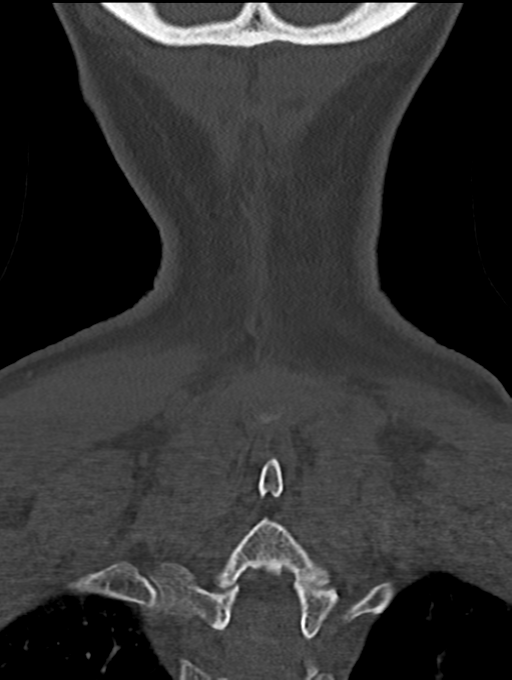 Chordoma (C4 vertebra) (Radiopaedia 47561-52188 Coronal bone window 57).png