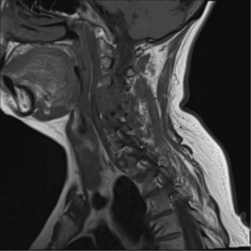 File:Chordoma (C4 vertebra) (Radiopaedia 47561-52189 Sagittal T1 10).png