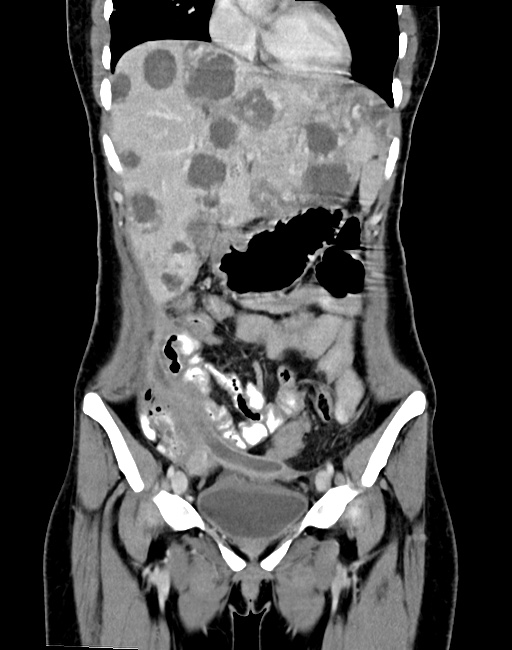 Choriocarcinoma liver metastases (Radiopaedia 74768-85766 B 39).jpg