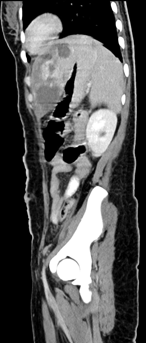 Choriocarcinoma liver metastases (Radiopaedia 74768-85766 C 65).jpg