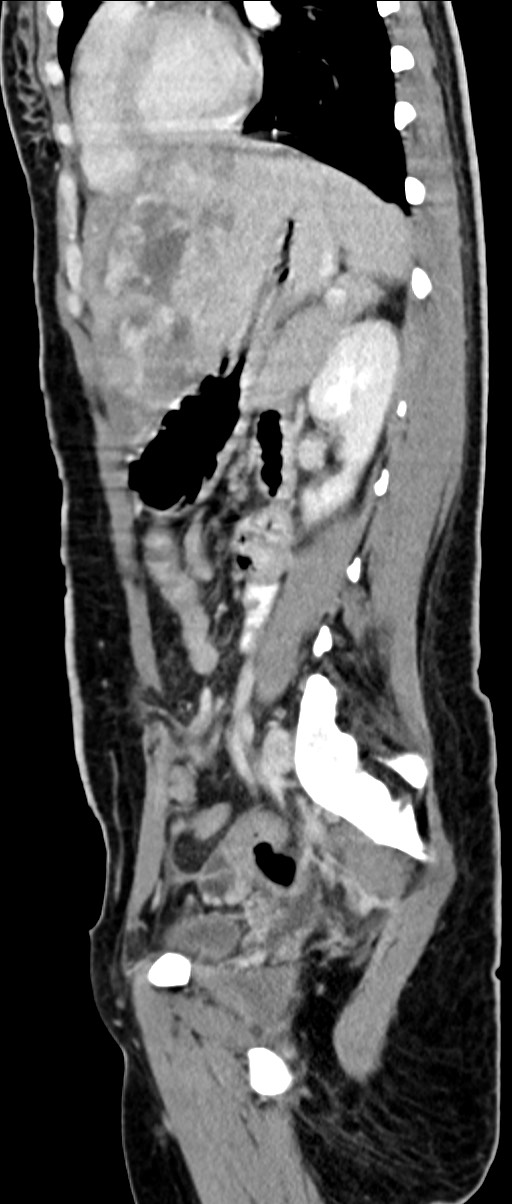 Choriocarcinoma liver metastases (Radiopaedia 74768-85766 C 79).jpg