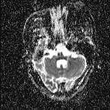 Choroid plexus xanthogranuloma - unilateral (Radiopaedia 85632-101393 Axial ADC 13).jpg