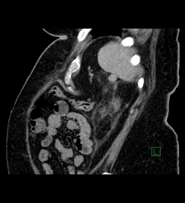 Chromophobe renal cell carcinoma (Radiopaedia 84239-99519 D 21).jpg
