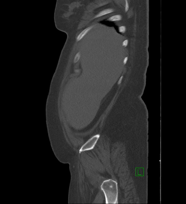 Chromophobe renal cell carcinoma (Radiopaedia 84239-99519 Sagittal bone window 95).jpg