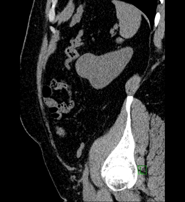 Chromophobe renal cell carcinoma (Radiopaedia 84286-99573 C 37).jpg