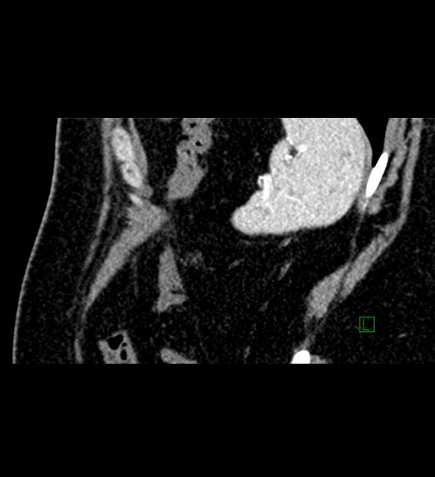 Chromophobe renal cell carcinoma (Radiopaedia 84286-99573 F 20).jpg