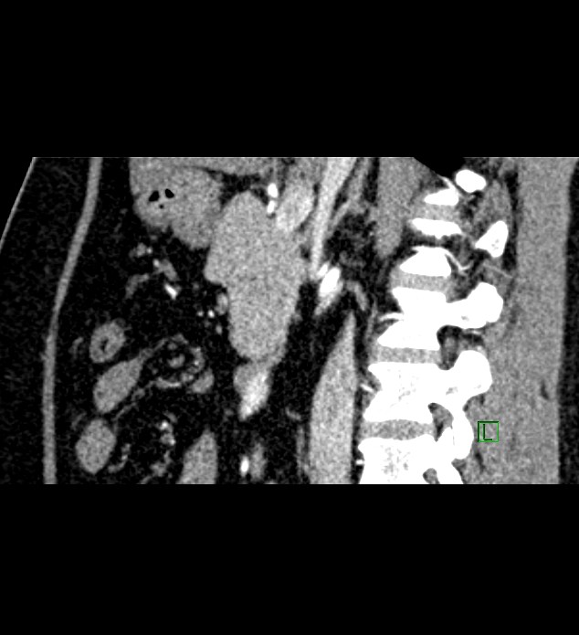 Chromophobe renal cell carcinoma (Radiopaedia 84286-99573 F 96).jpg