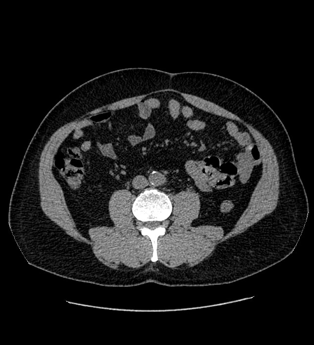 Chromophobe renal cell carcinoma (Radiopaedia 84337-99693 Axial non-contrast 82).jpg