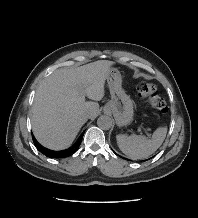 Chromophobe renal cell carcinoma (Radiopaedia 86879-103083 Axial non-contrast 8).jpg