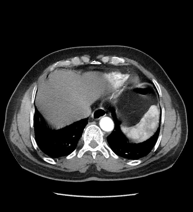 Chromophobe renal cell carcinoma (Radiopaedia 86879-103083 B 17).jpg